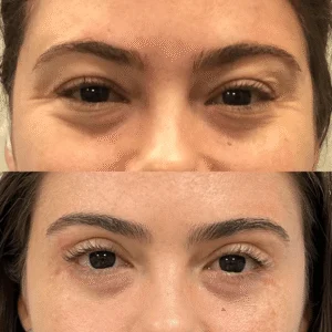 Dra Helena Fraga Antes e Depois Blefaroplastia 02