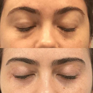 Dra Helena Fraga Antes e Depois Blefaroplastia 01