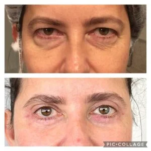 Dra. Helena Fraga Resultado Blefaroplastia 01