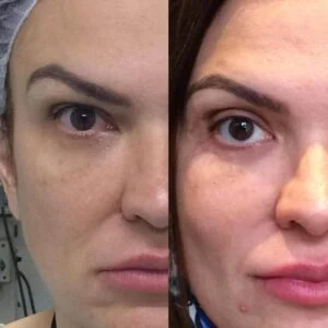 Dra. Helena Fraga Resultado Blefaroplastia 04