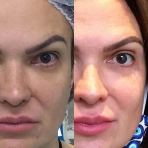 Dra. Helena Fraga Resultado Blefaroplastia 05