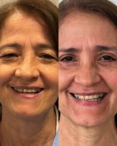 Dra. Helena Fraga Resultado Blefaroplastia 07