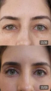 01 Dra Helena Fraga Resultado Blefaroplastia