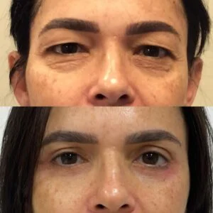 02 Dra Helena Fraga Resultado Blefaroplastia