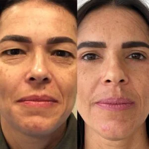 03 Dra Helena Fraga Resultado Blefaroplastia