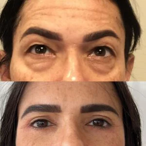 04 Dra Helena Fraga Resultado Blefaroplastia