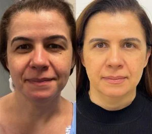 05 Dra Helena Fraga Resultado Blefaroplastia