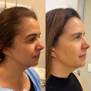 06 Dra Helena Fraga Resultado Blefaroplastia