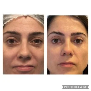 07 Dra Helena Fraga Resultado Blefaroplastia
