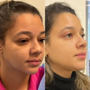 08 Dra Helena Fraga Resultado Blefaroplastia