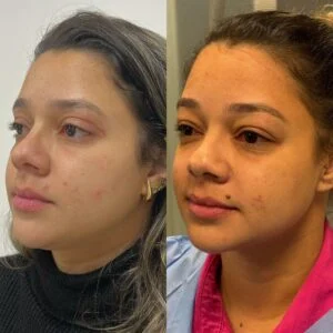 09 Dra Helena Fraga Resultado Blefaroplastia