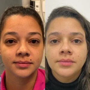 10 Dra Helena Fraga Resultado Blefaroplastia