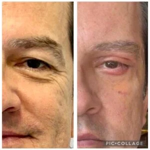 13 Dra Helena Fraga Resultado Blefaroplastia