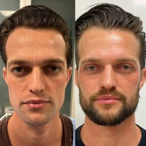 12 Dra Helena Fraga Resultado Blefaroplastia