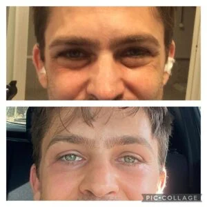 11 Dra Helena Fraga Resultado Blefaroplastia