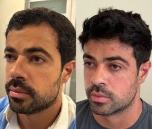 14 Dra Helena Fraga Resultado Blefaroplastia
