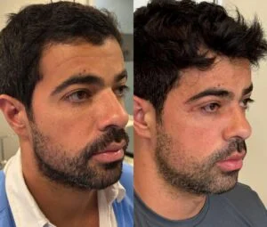 15 Dra Helena Fraga Resultado Blefaroplastia