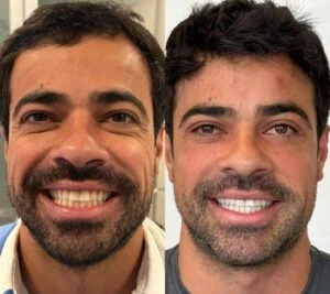 16 Dra Helena Fraga Resultado Blefaroplastia