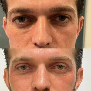 19 Dra Helena Fraga Resultado Blefaroplastia