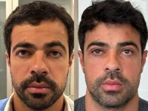 18 Dra Helena Fraga Resultado Blefaroplastia