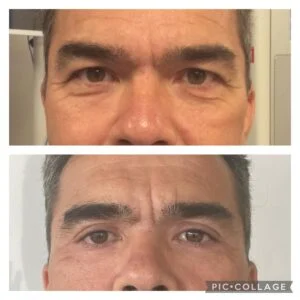 17 Dra Helena Fraga Resultado Blefaroplastia