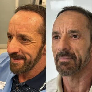 20 Dra Helena Fraga Resultado Blefaroplastia