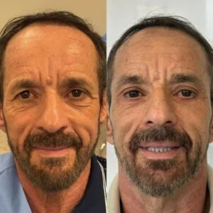 21 Dra Helena Fraga Resultado Blefaroplastia