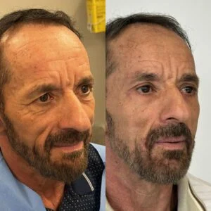 22 Dra Helena Fraga Resultado Blefaroplastia